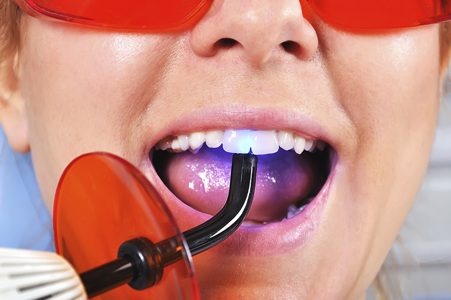 Пломбирование зубов химическими и световыми пломбами в Караганде