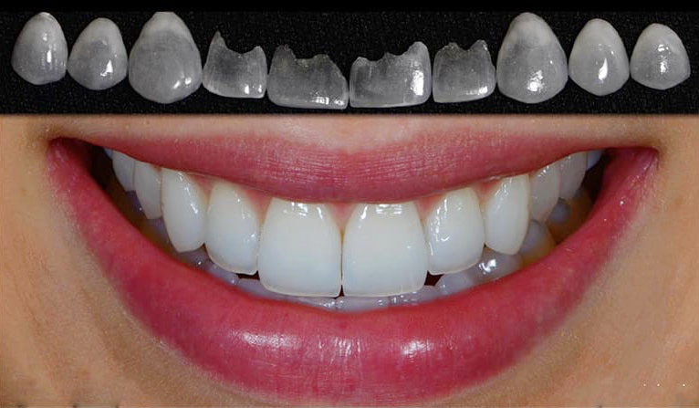 люминиры стоматология